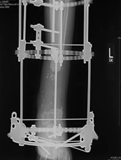 Osteomyelitis