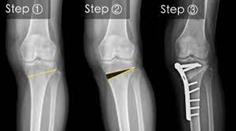 Osteotomy