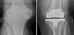 Knee Surgery